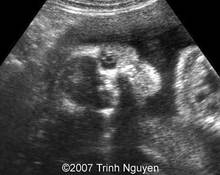 Amniotic band syndrome imitating Tessier cleft image
