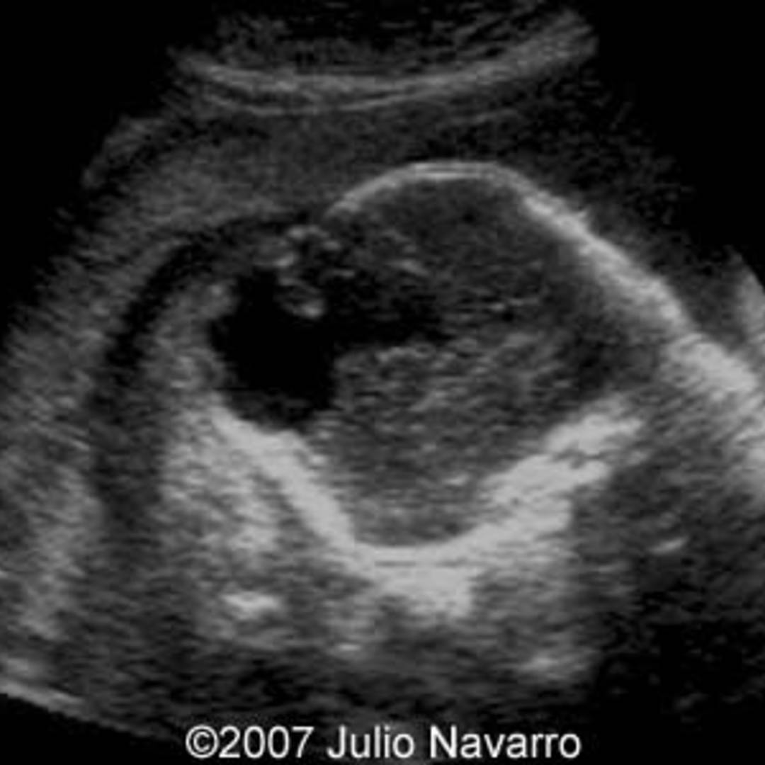 📃 Amniotic band syndrome