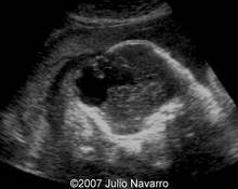 Amniotic band syndrome image