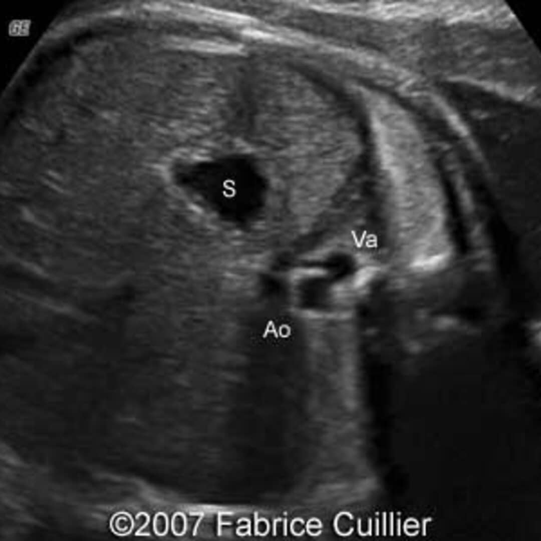 📃 Visceral situs inversus