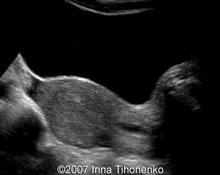 Cervical pregnancy image