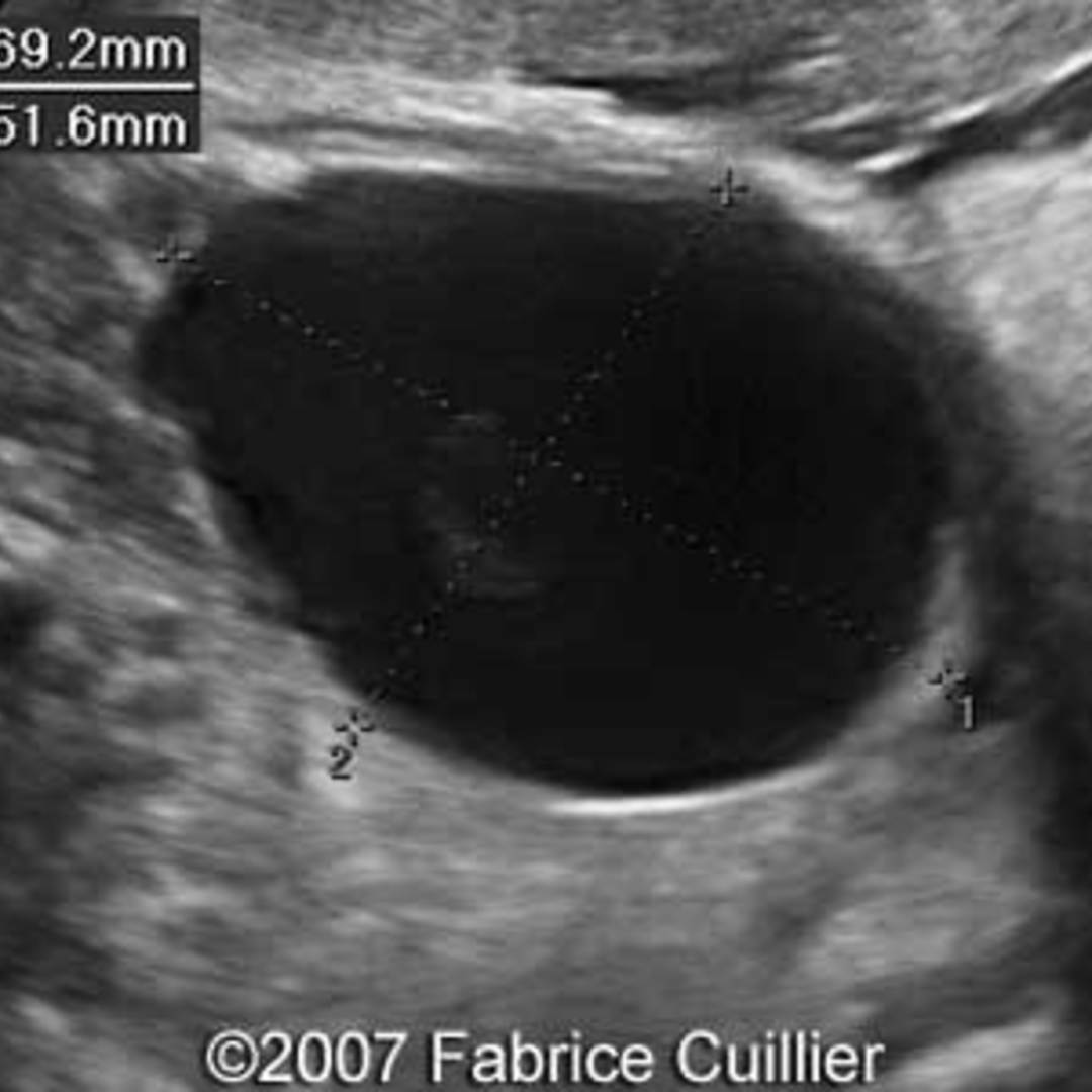 📃 Ovarian Cyst 5959