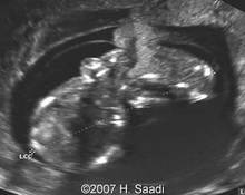 Limb body wall complex associated with placenta previa accreta image