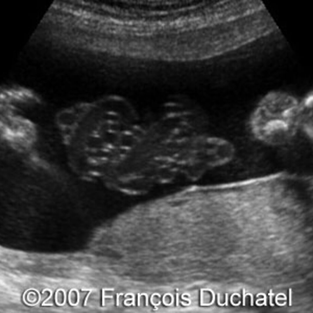 📃 Cord entanglement