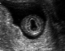 Holoprosencephaly, 11 weeks image