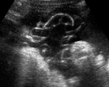 Umbilical artery thrombosis image