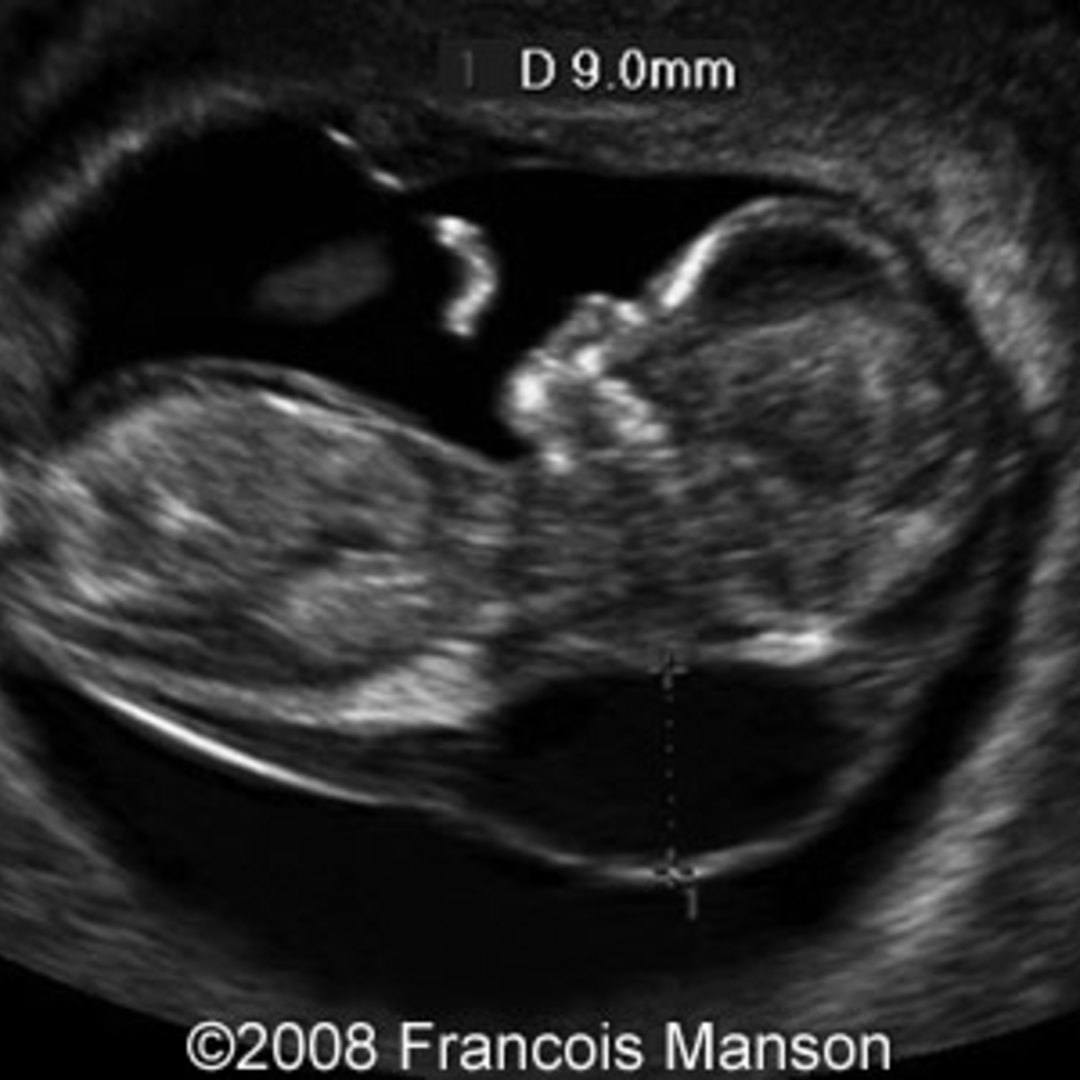  cystic hygroma monosomy x