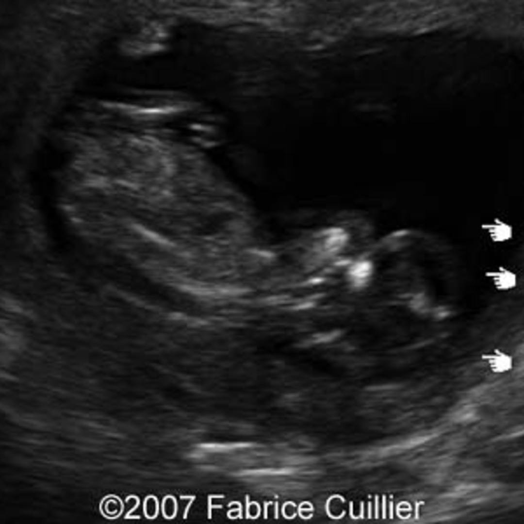 📃 Amniotic band syndrome