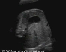 Esophageal atresia with tracheo-esophageal fistula image