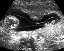 Amniotic bands image