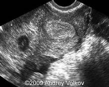 Ectopic pregnancy, tubal, interstitial - two cases image