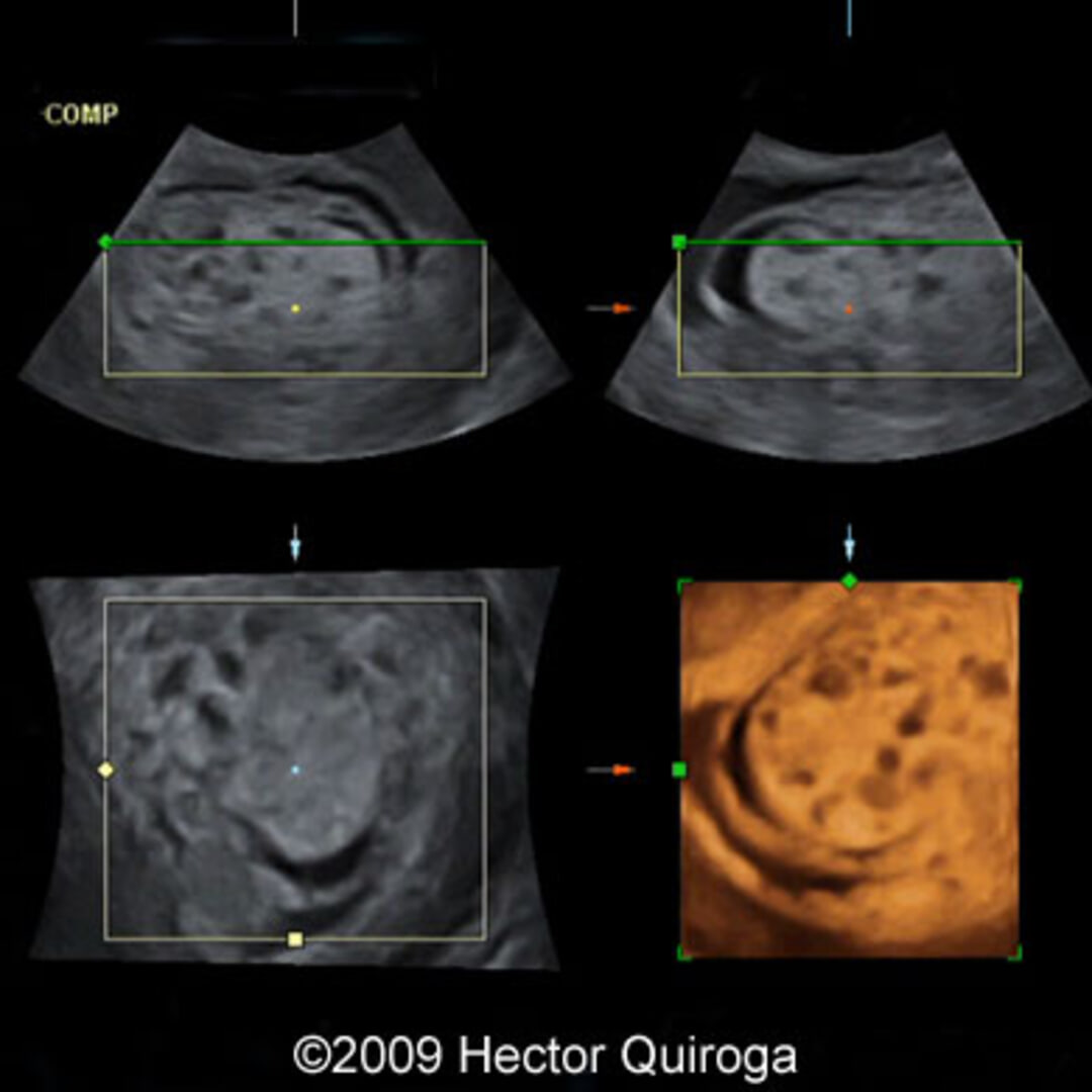 📃 Molar pregnancy