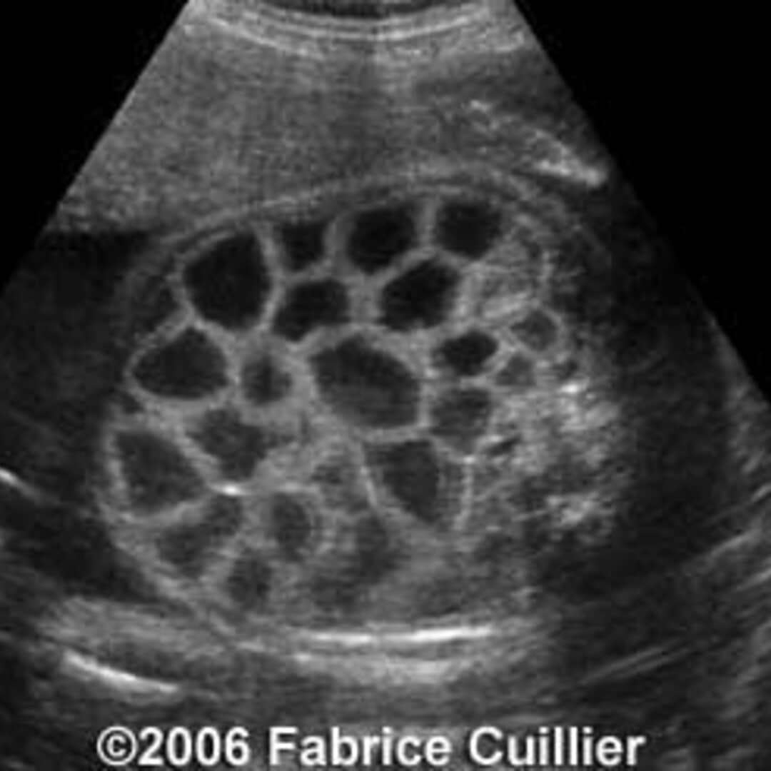 📃 Congenital chloride diarrhea