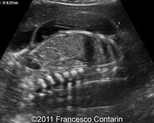 Lymphangioma, thoraco-abdominal image