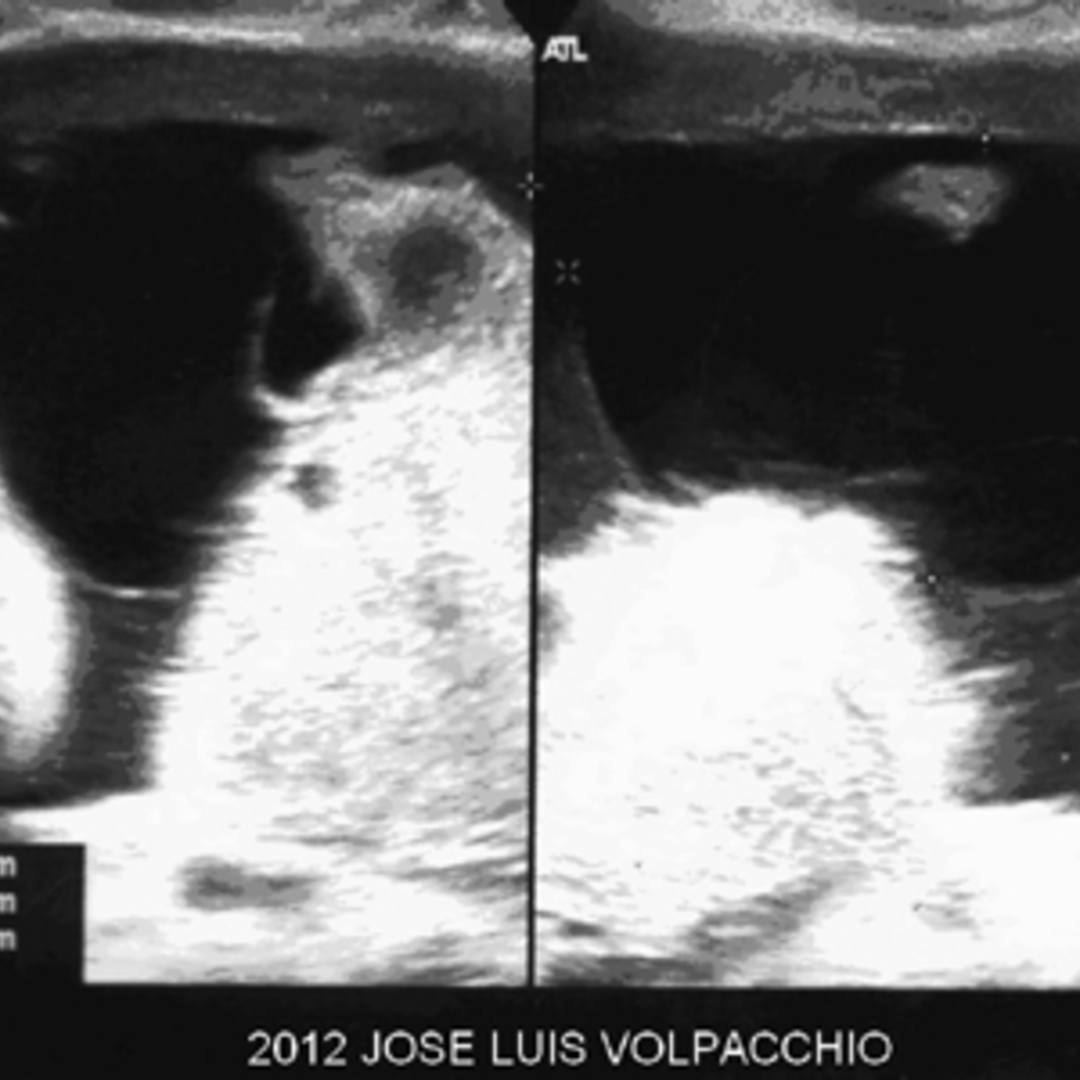 📃 Placental cyst