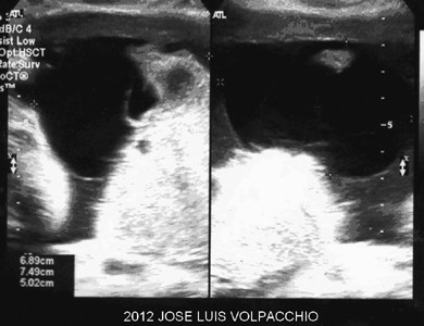 📃 Placental cyst