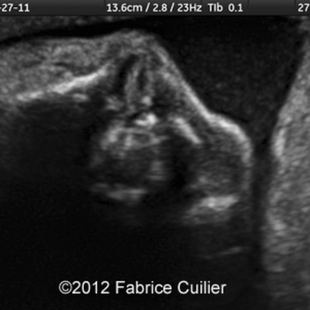 cleft lip 3d ultrasound