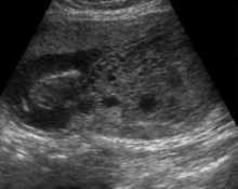 Molar pregnancy with normal fetus image
