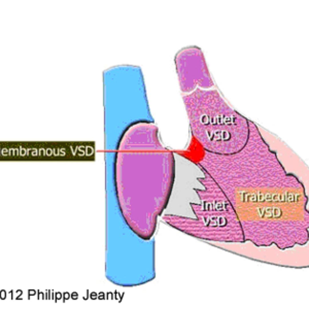 📃 Ventricular septal defect, muscular