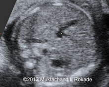 Persistent right-sided umbilical vein image