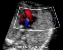 Early mitral anomalies image