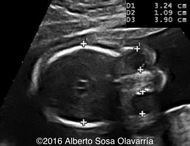 microcephaly ultrasound