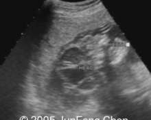 Acrania due to amniotic band image