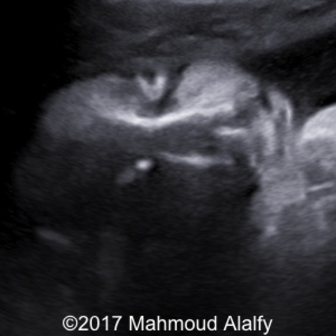 📃 Harlequin Ichthyosis