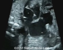 Horseshoe lung malformation associated with classic scimitar syndrome image