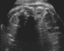Hypoplastic kidney, unilateral image