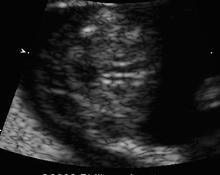 Trisomy 18, 11 weeks with nuchal translucency image