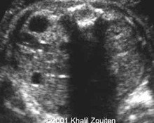 Ureterocele, ectopic in the proximal urethra image