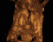 Twins, conjoined, 12 weeks, 3D image