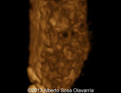 📃 Partial molar pregnancy with normal diploid fetus