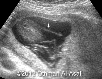 📃 Incomplete rupture of amniotic membrane