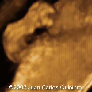 18 weeks right arm 18 weeks