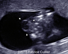 Thoracic meningocele - 1º trimester image