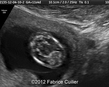  Meckel-gruber syndrome at 12 weeks image