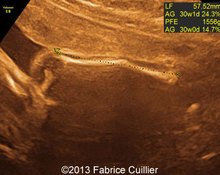 Proximal femoral hypoplasia, unilateral image