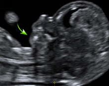 Treacher Collins syndrome – role of 3D/4D ultrasound in the assessment of fetal facial dysmorphism image
