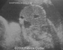 Abnormal triplet pregnancy image