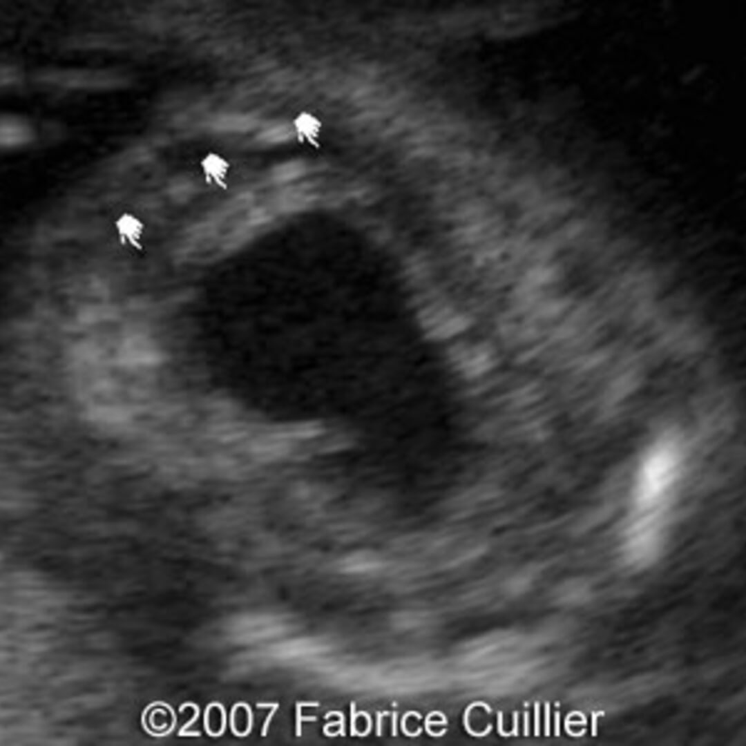  Posterior Urethral Valves
