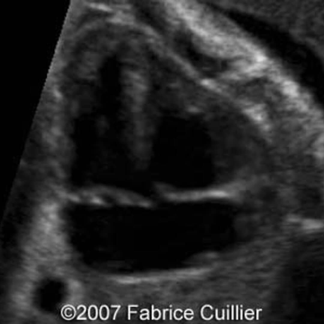 📃 Trisomy 21, ventricular septal defect