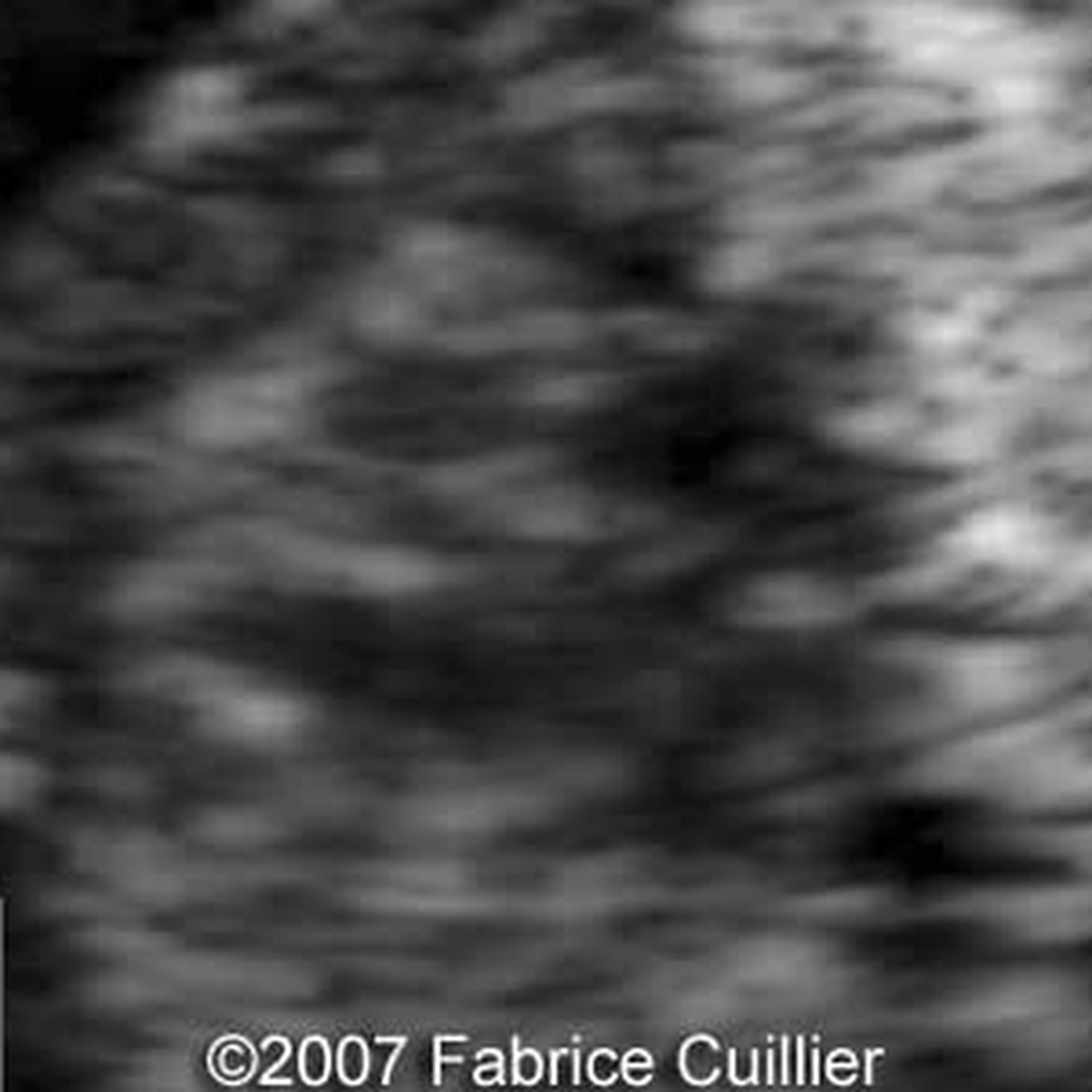 📃 Trisomy 22 mosaicism