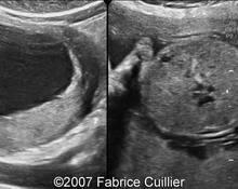 Acardiac twin, 25 weeks image