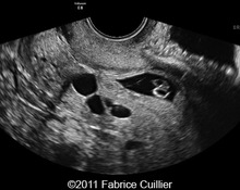 Pregnancy in cesarean scar, four cases image