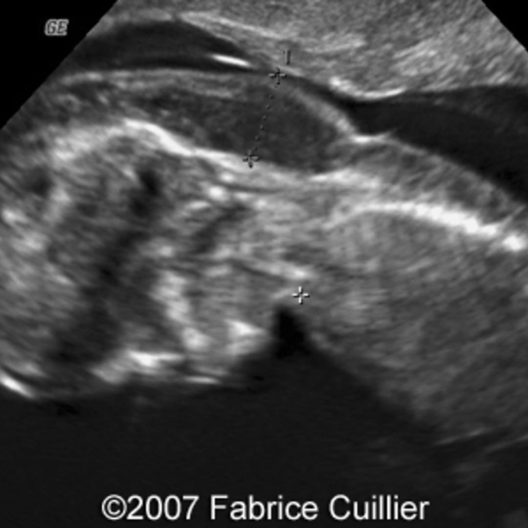 📃 Cystic hygroma, Turner syndrome