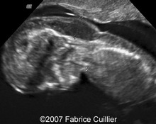 Cystic hygroma, Turner syndrome image