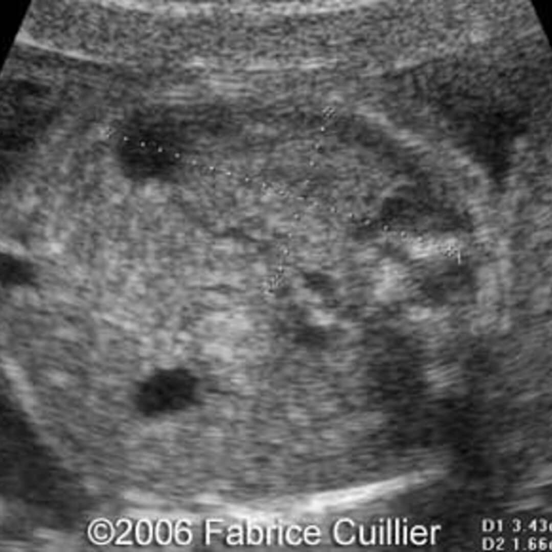📃 Multicystic kidney disease, unilateral