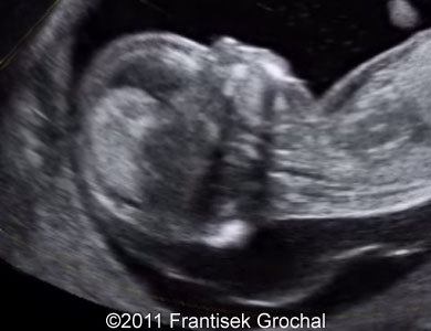 12 week ultrasound down syndrome pictures